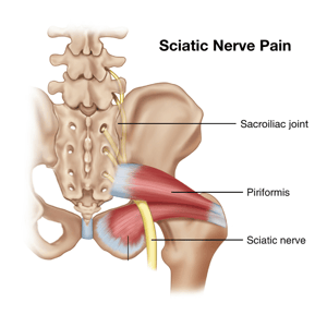 Sciatica and Your Hip Pain